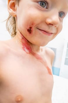 medical procedure dressing a boy with a first-degree burn from boiling water on his face, neck and chest