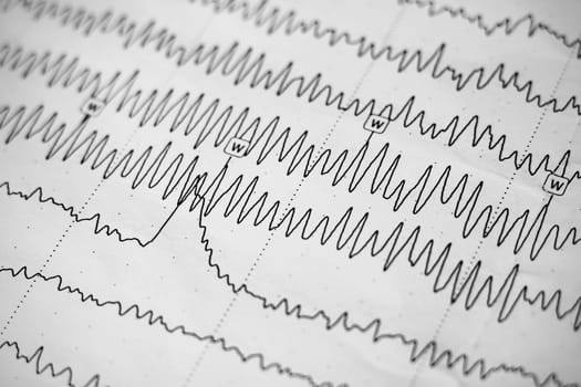 Electroencephalogram result on paper close up, brain activity test, diagnosis of epilepsy