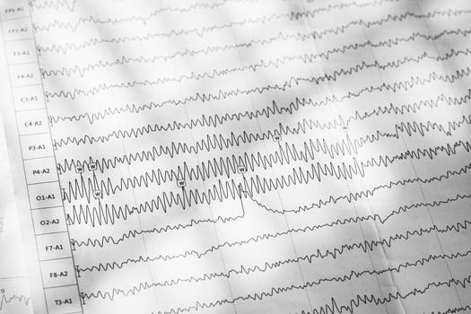 Electroencephalogram result on paper close up, brain activity test, diagnosis of epilepsy