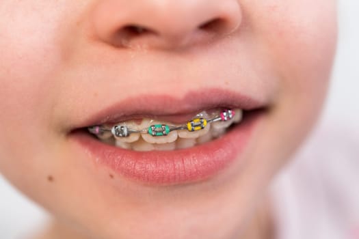 Close-up of the mouth of a girl with rainbow braces.