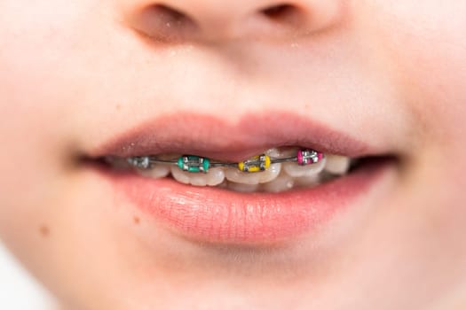 Close-up of the mouth of a girl with rainbow braces.