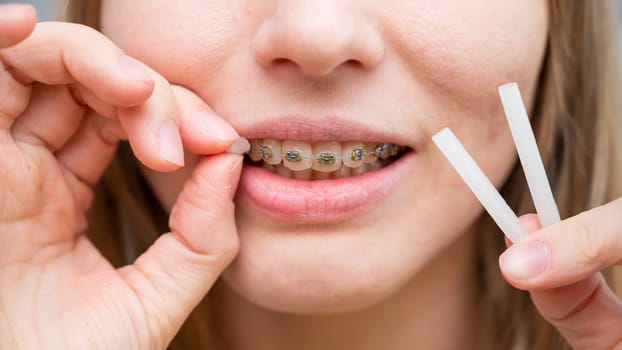 Close-up portrait of a woman with braces using special orthodontic wax