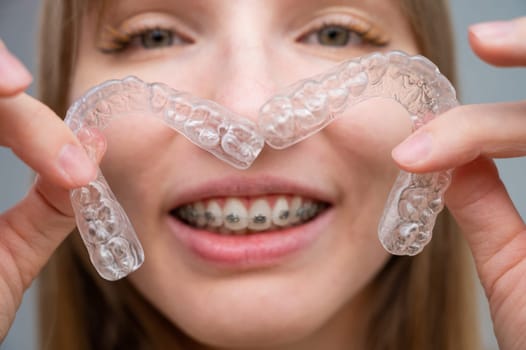 Woman with braces on her teeth holding and removable transparent aligners