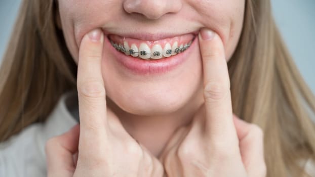 Close-up of a young woman's smile with metal braces on her teeth. Correction of bite.