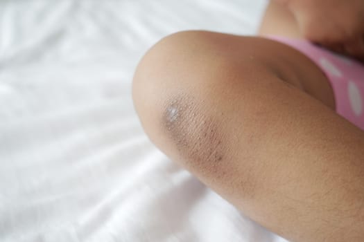 stain bruise wound on child knee