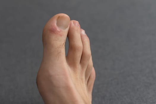 close-up of a man's toes with fungal disease, skin cracking and callus formation on his toes