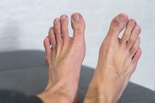 A man's toes showing what looks like a rash with red blotchy skin. A common side effect of Covid-19 often referred to as Covid toe