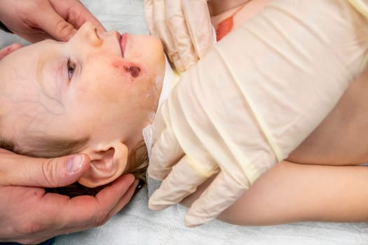 medical procedure dressing a boy with a first-degree burn from boiling water on his face, neck and chest