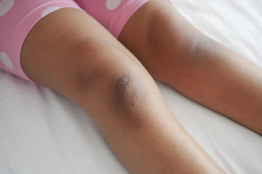 stain bruise wound on child knee