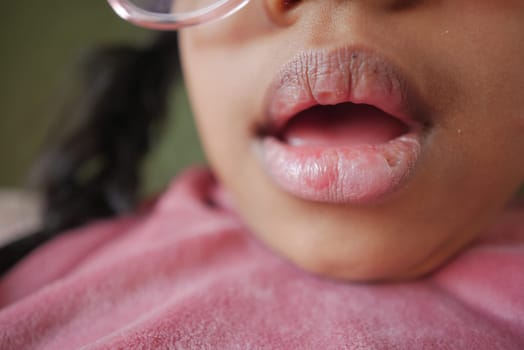 close up of dry lip of a child ,