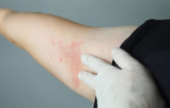 Close-up red rash on white skin hand, examination. Doctor touches an allergic rash with gloves. Diseased skin patient. Health problems, allergies to medicines or fungal infections