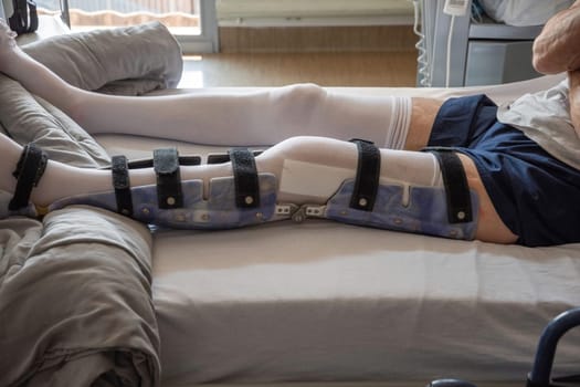 a man with a broken leg in an orthosis on a bed in a clinic after an accident and a fracture of the femur, high-quality medical care and postoperative care for the patient, high-quality photo