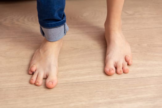 Close-up of the feet of a thirteen-year-old girl with a birth defect. Disability prevents the girl from walking and developing normally.