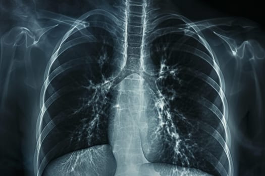 X-ray human lungs with cystic fibrosis, medical concept. Generative AI.