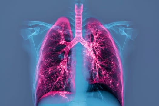 X-ray human lungs with cystic fibrosis, medical concept. Generative AI.