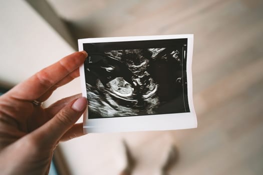 Prenatal ultrasound screening. Woman hand holding ultrasound pregnancy image of baby. Concept of pregnancy, maternity, expectation for baby birth. High quality photo