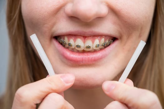 Close-up portrait of a woman with braces using special orthodontic wax