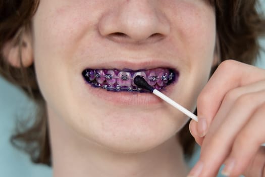 Plaque indicator on human teeth with braces. Plaque is colored pink. Teenager using plaque indicator gel. Teeth care