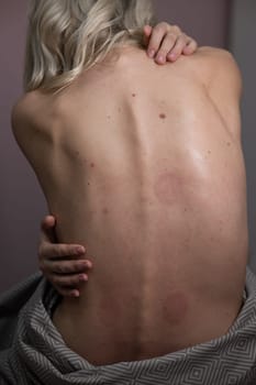 Caucasian woman after back massage with vacuum cups. Vertical photo