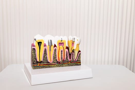 Mockup Dental Tooth Implant, Bridge Or Crown Model On Table, White Background, Copy Space. Dummy Template Human Jaw Oral Dentures. Prosthesis On Metal Peg. Horizontal Plane. High quality photo