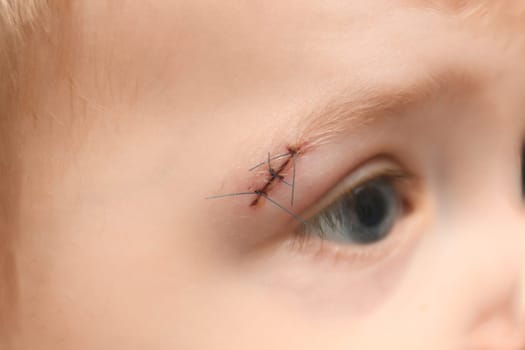 Wound on the eyebrow of a child after a bruise