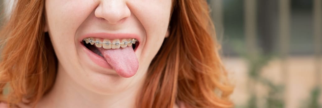 Young woman with braces on her teeth smiles and shows her tongue outdoors. Widescreen