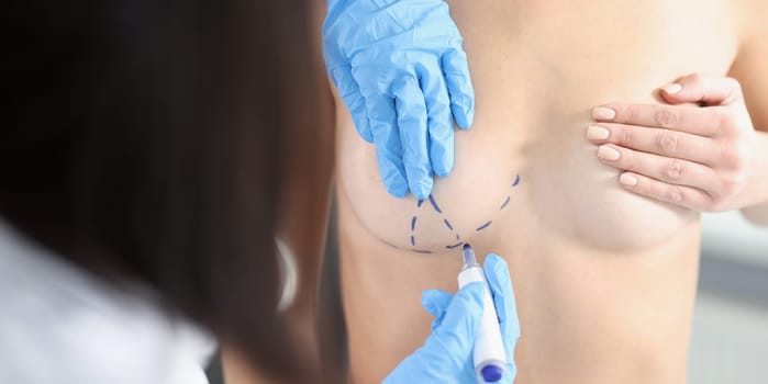 The doctor's hands draw with a marker on the female breast, close-up. Preparation for mammoplasty