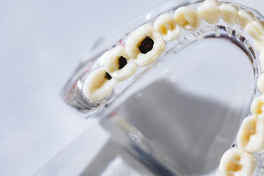 Caries tooth model, oral care concept. Dental model present common dental disease such as caries, wisdom tooth. Oral health. Copy space. Problems with teeth health