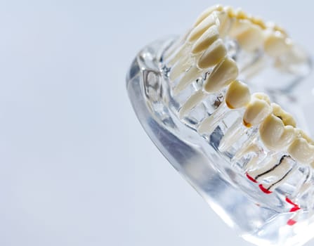 Dental implant, artificial tooth roots into jaw, root canal of dental treatment, gum disease, teeth model for dentist studying about dentistry.