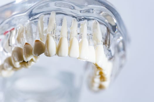 Dental implant, artificial tooth roots into jaw, root canal of dental treatment, gum disease, teeth model for dentist studying about dentistry.