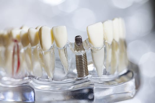 Dental tooth implant titanium prosthetic dentists model. Shallow dof