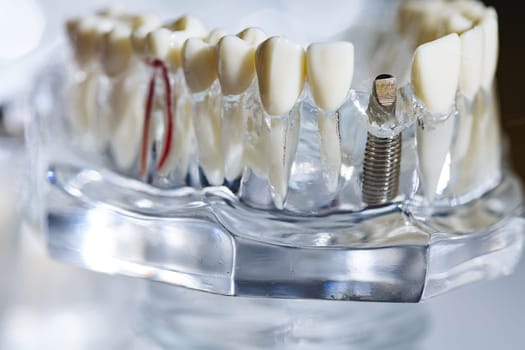 Dental tooth implant titanium prosthetic dentists model. Shallow dof