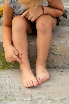 A child has a scratch on his leg. Selective focus. Kid.