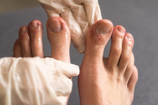 covid toes, bites on a man's toes