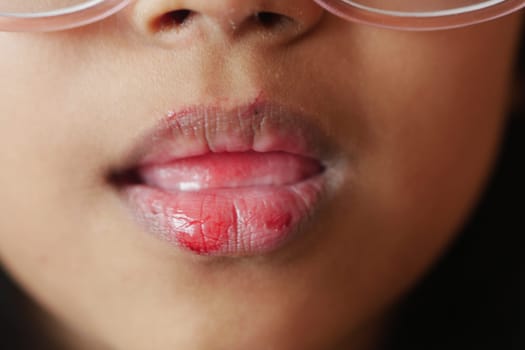 close up of dry lip of a child ,