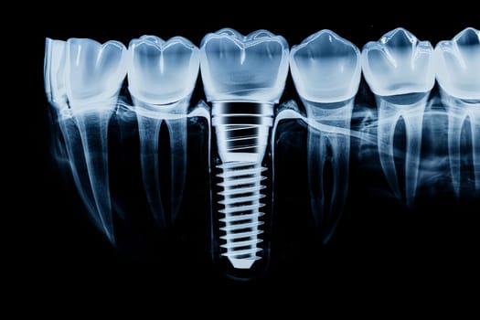 dental implant placement. An X-ray image displaying a dental implant anchored in the jawbone. . Generative Ai.