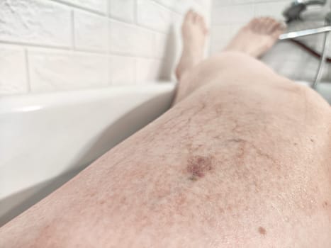 Close-Up of Varicose Veins on a Leg in the Bathtub. Leg with varicose veins while submerged in bathtub, highlighting the health condition