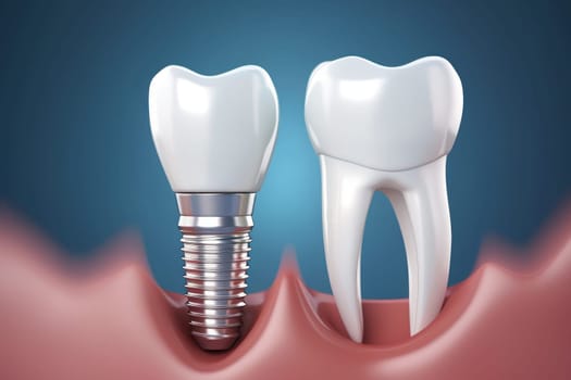 Realistic dental implant. Teeth treatment. Generate Ai