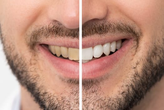 Teeth before and after whitening. Dental care concept