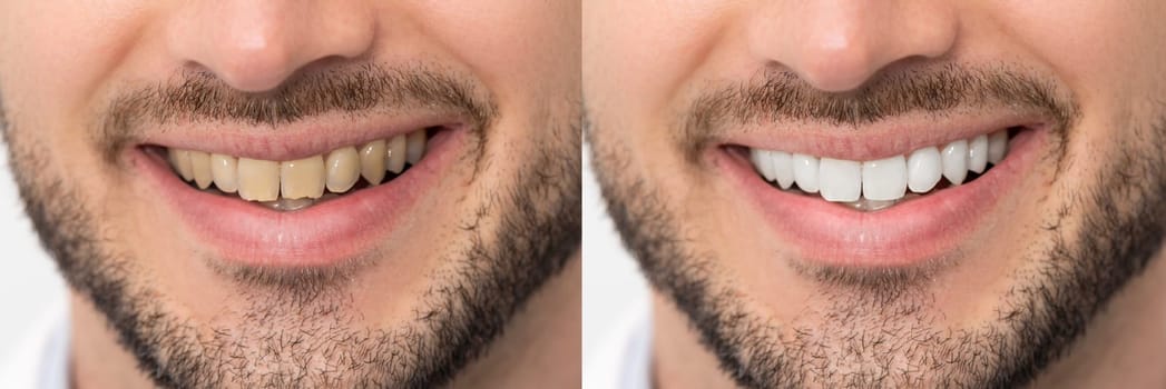 Teeth before and after whitening. Dental care concept