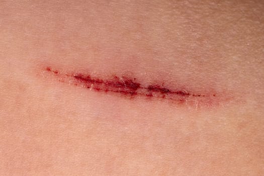 Close-up of a healed scar on skin. Macro shot with copy space. Health care and medical concept. Design for educational material