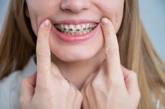 Close-up of a young woman's smile with metal braces on her teeth. Correction of bite.