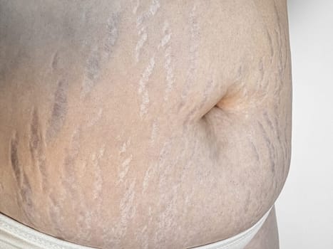 Close up of stretch marks on womans skin, highlighting natural beauty and the concept postpartum changes. High quality photo