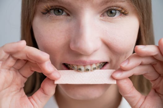 Young woman with metal braces on her teeth is chewing gum. The girl is eating gummy candy.