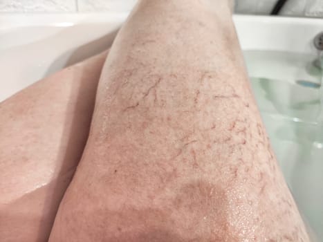Close-Up of Varicose Veins on a Leg in the Bathtub. Leg with varicose veins while submerged in bathtub, highlighting the health condition