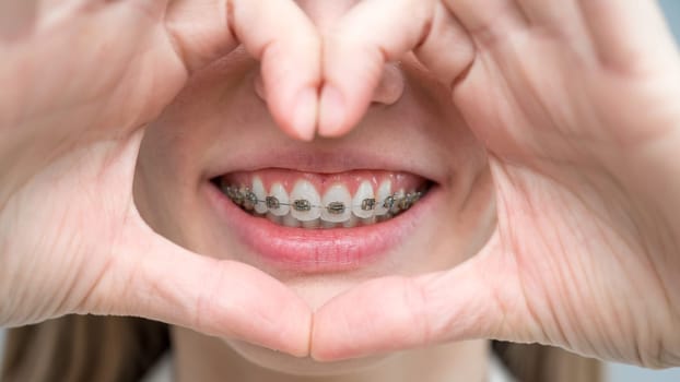 Caucasian woman in braces holding fingers in the shape of a heart