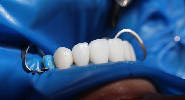Installation of veneers and dental implants in clinic closeup. Dental prosthetics concept