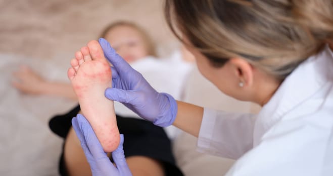 Doctor conducts medical examination of leg of child with red itchy rash closeup. Enterovirus infection symptoms and treatment concept