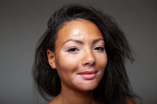 Black African American woman with Vitiligo pigmentation skin problem. Closeup portrait of happy lady with dark hair looking at camera on gray background.