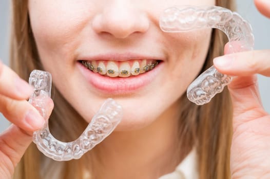 Woman with braces on her teeth holding and removable transparent aligners